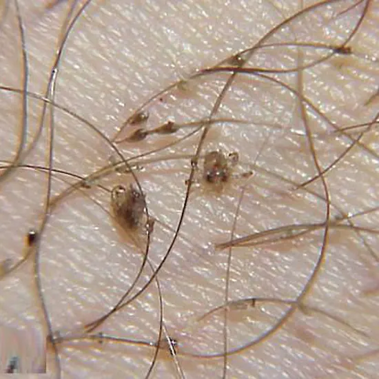 Pediculosis Pubis (Public Lice Crab Lice)